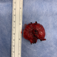 Illustration for article titled Tumor take out - update